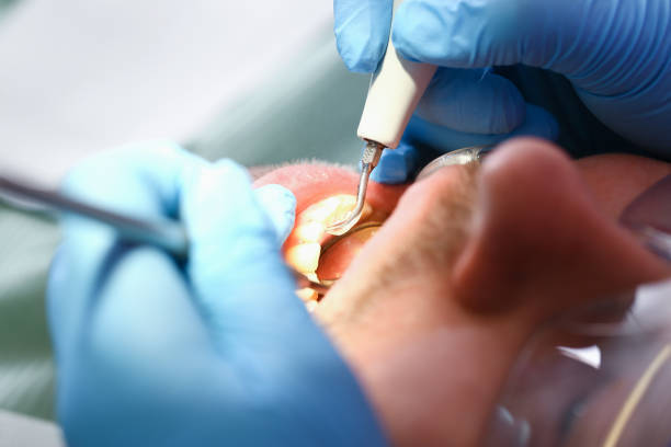 Best Urgent Care for Lost Fillings or Crowns in Corydon, IN